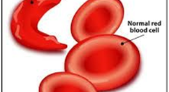 Good News: First Sickle Cell Patient gets cured with gene therapy