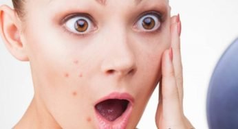 How To Remove Pimples – How To Get Rid Of Pimples Fast.