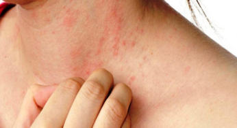 Common Causes of Eczema and How to prevent it.
