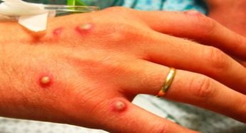 MonkeyPox Infection – How To Avoid Monkey Pox Disease