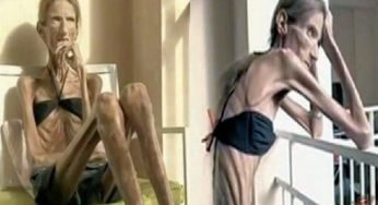 5 Skinniest People – Skinniest People Ever in the Word